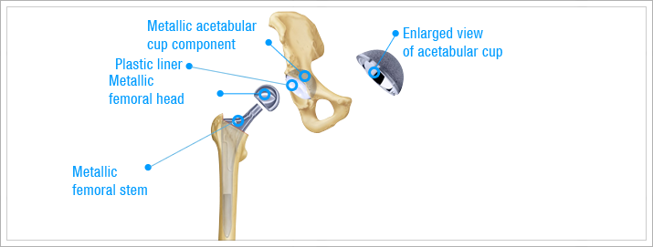 Hip Replacement Surgery