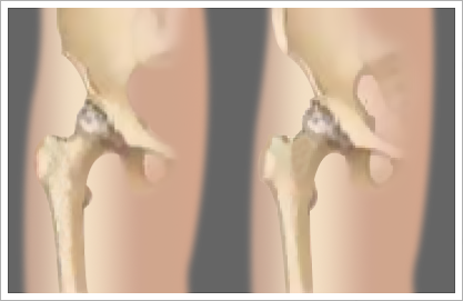 minimally-invasive-hip-replacement-surgery