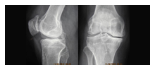 osteoarthritis