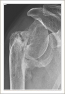 Failed Fracture treatment with stiffness