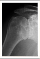 Normal shoulder