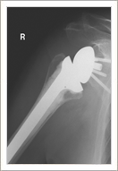 Reverse Shoulder Arthroplasty