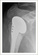 Trauma Hemiarthroplasty