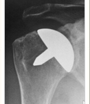 Resurfacing Shoulder Arthroplasty