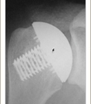 ‘Stemless’ Shoulder Arthroplasty