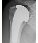 Short stem Total Shoulder Arthroplasty