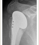 Trauma Hemiarthroplasty